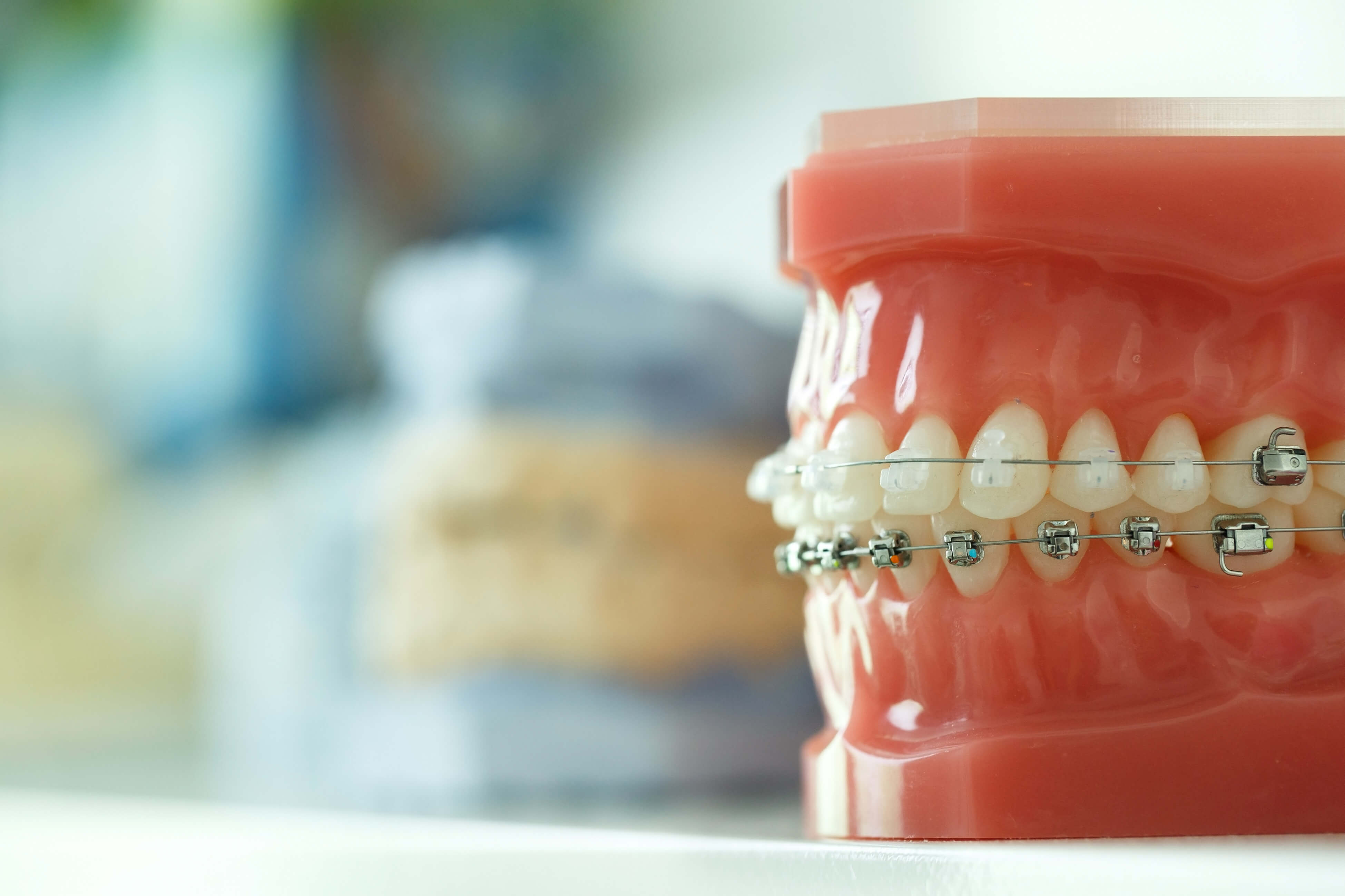 Model of human teeth with invisible braces on top row, regular braces on bottom teeth 