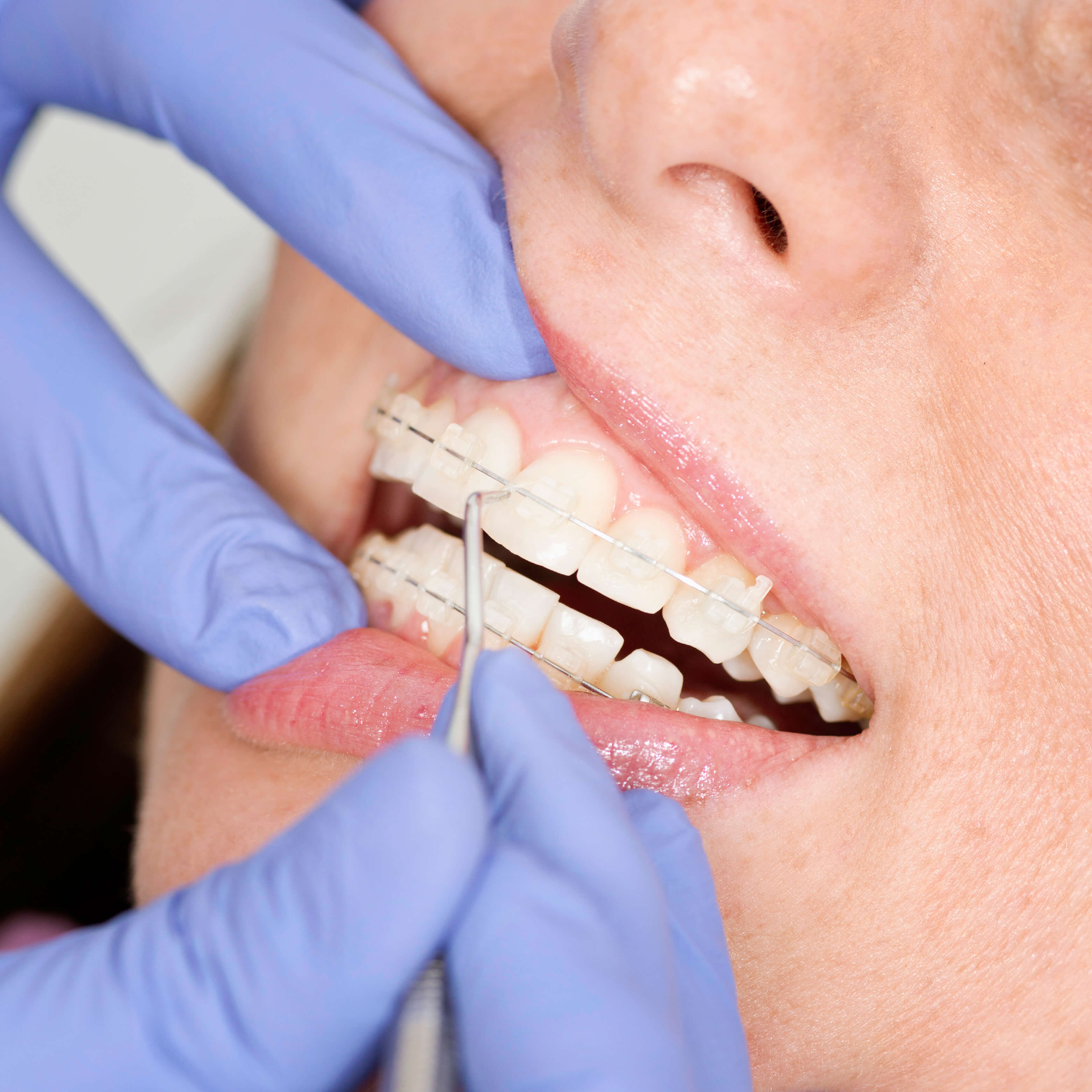 Patient with invisible braces getting teeth cleaned 