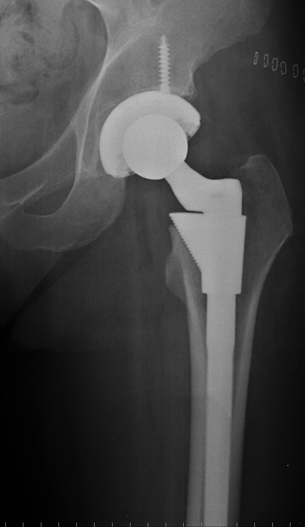 X-ray of a hip implant