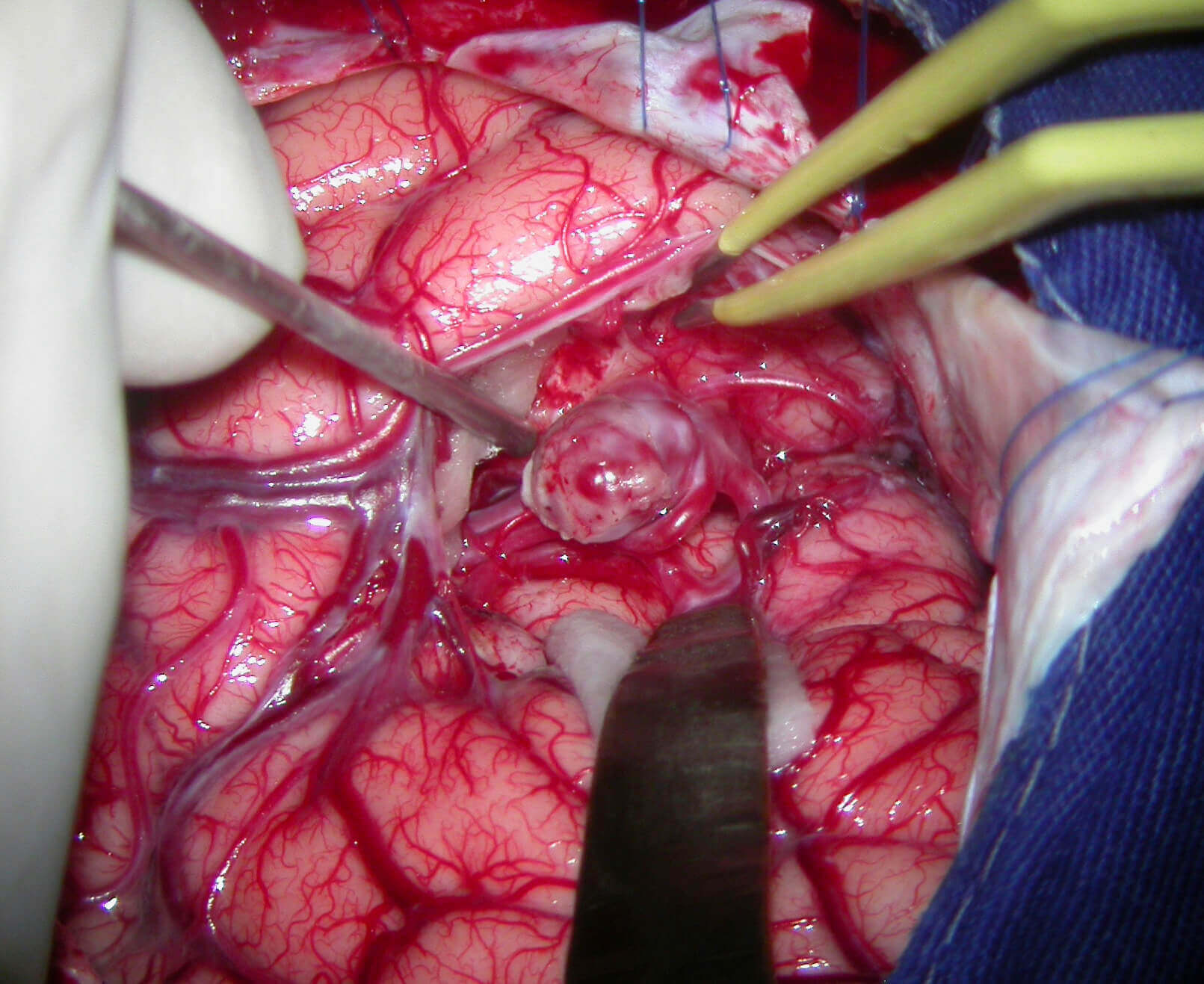 Open brain surgery 