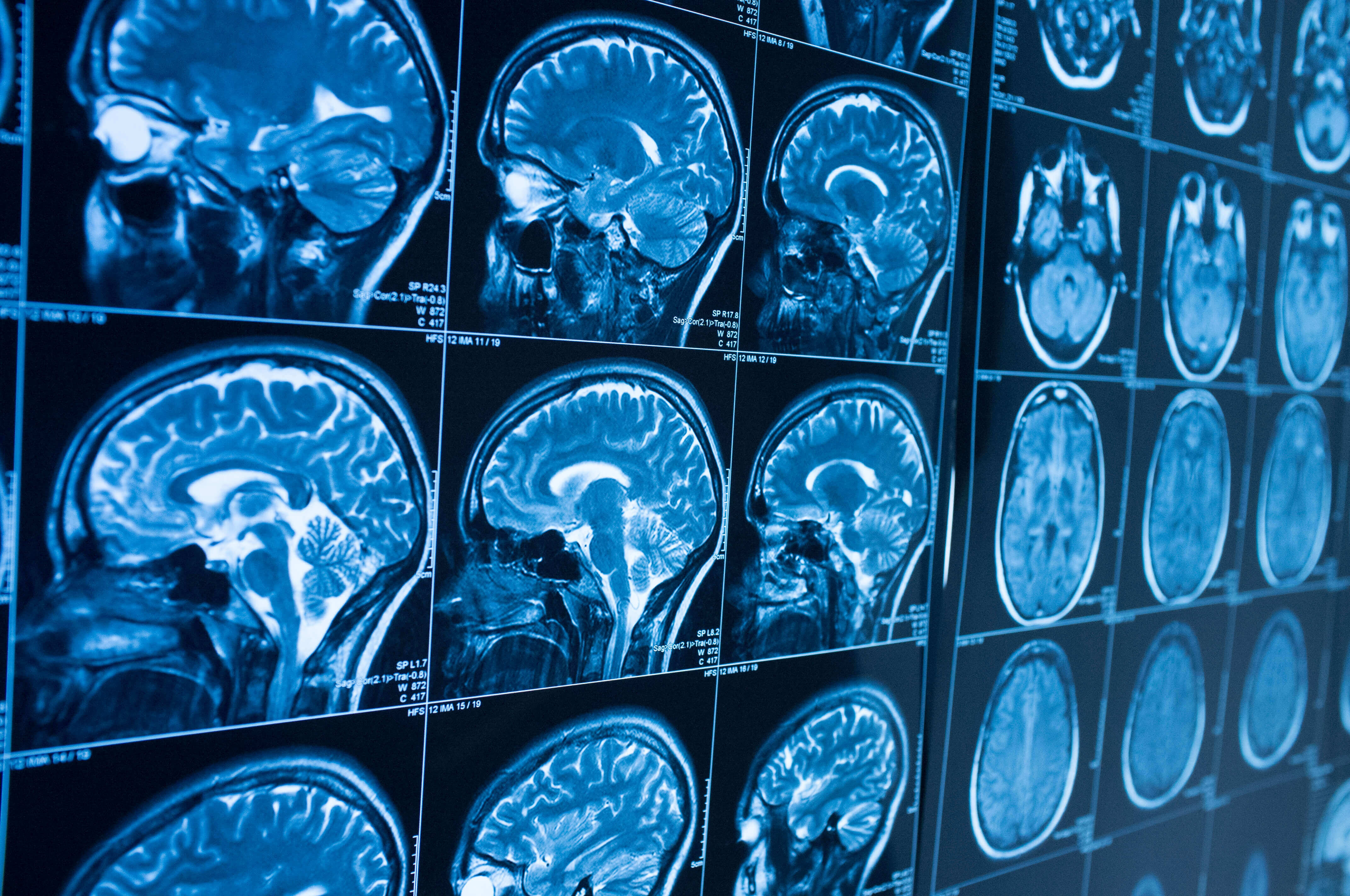 MRI images of a human head 