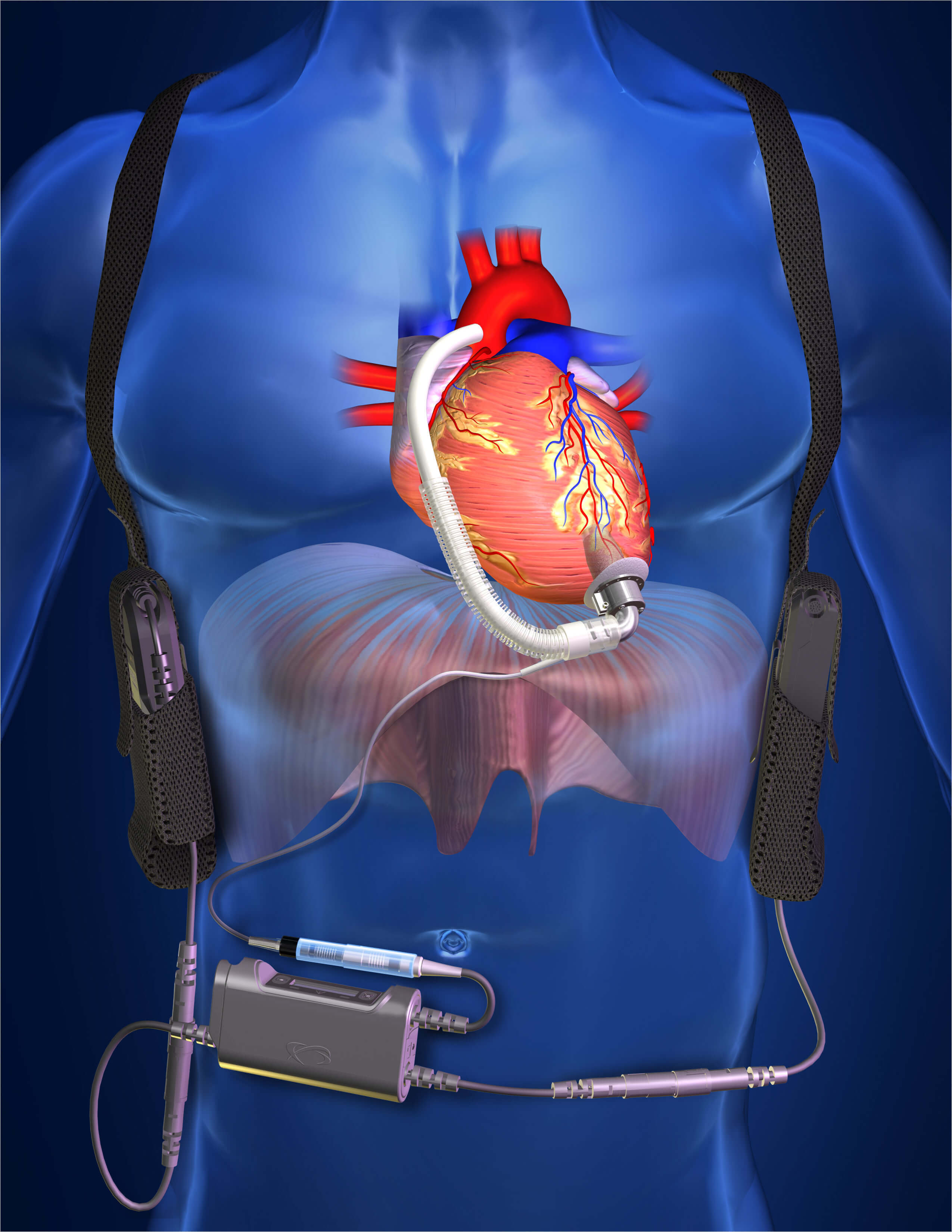 Illustration of a ventricular assist device implanted in a patient 