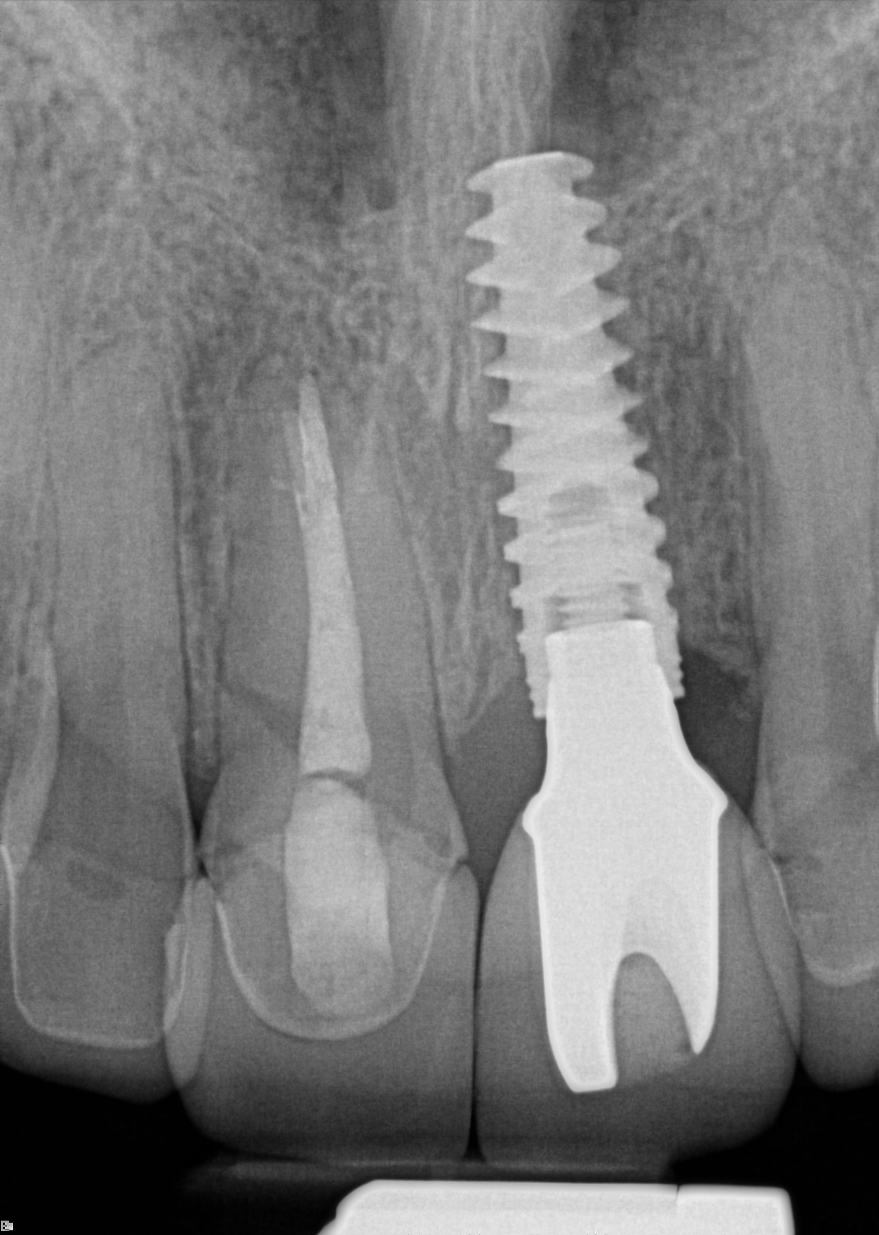X-ray of a tooth implant 